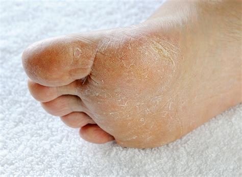 athlete's foot hornsby|athlete's foot australia sale.